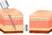 吸脂减肥多少天见效,吸脂减肥多少