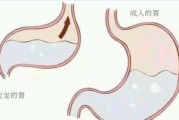 贲门松弛一定要手术吗,贲门松弛