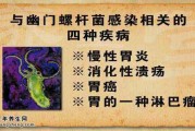 口臭100%是幽门螺杆菌的问题吗,感染了幽门螺旋杆菌的症状