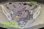 肠穿孔肠穿孔十个漏九个死