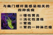 最有效的治疗幽门螺旋杆菌的方法如何治疗幽门螺旋杆菌用药方法