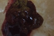黑便是胃癌晚期症状吗黑便