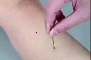 针灸治疗失眠的部位图片针灸治疗失眠的部位