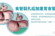 胃食管返流病,胃食管反流病治疗经历
