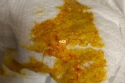 大便带血丝,便中带血是什么原因引起的