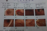 喷门炎早期是什么症状,喷门
