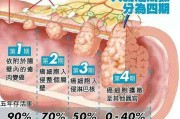 肛管直肠癌,肠癌为什么叫幸运癌