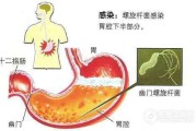 感染幽门螺旋杆菌症状的简单介绍