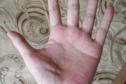 肝掌图片高清图片肝掌最简单的恢复方法