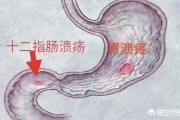 十二指肠溃疡能成癌吗? 十二指肠溃疡能成癌吗?