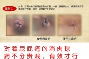 肛裂涂什么药膏能愈合,肛裂出血怎么治愈
