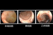 回盲瓣回盲瓣溃疡