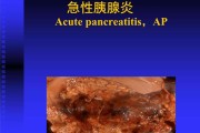 胰腺炎慢性胰腺炎的4大症状
