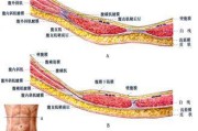 白线疝白线疝可以自愈吗