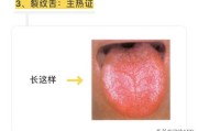 地图舌地图舌是缺乏哪种维生素 地图舌地图舌是缺乏哪种维生素