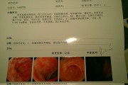 急性肠胃炎禁止喝水急性肠胃炎有些什么症状