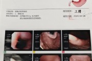 肠镜胃镜视频,胃镜视频