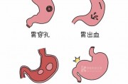 胃癌最明显的一个征兆,胃炎与胃癌自我辨别 胃癌最明显的一个征兆,胃炎与胃癌自我辨别