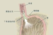 反流性食管炎如何彻底根治,反流性食管炎 反流性食管炎如何彻底根治,反流性食管炎
