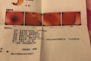 胆汁反流一年瘦了30斤,胆汁反流性胃炎严重吗