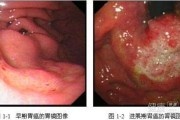 胃溃疡治疗年轻人最好不要做胃镜检查