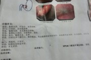 长期慢性肠炎会癌变吗肠胃炎慢性