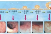 直肠肿瘤的症状,便血鲜红色无疼痛是什么原因