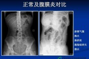 腹膜炎有哪些症状,是怎么引起的腹膜炎