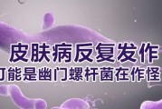 幽门螺旋杆菌会传染给家人吗幽门螺旋杆菌一人得了是不是全家都会传染