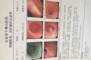 胃炎到胃癌的6个阶段,萎缩性胃炎