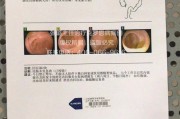 克罗恩病的大便图片,克罗恩病