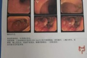乙状结肠冗长,乙状结肠冗长手术是微创手木吗?