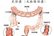 大肠癌的早期能治愈吗大肠癌的早期症状 大肠癌的早期能治愈吗大肠癌的早期症状