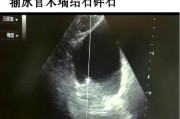 尿路结石怎么排出快,尿路结石