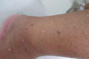 疣状增生萎缩性胃炎c2伴疣状增生 疣状增生萎缩性胃炎c2伴疣状增生