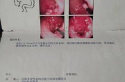 结肠炎的症状结肠有哪些症状