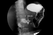 十二指肠球部溃疡h1期什么意思十二指肠球部溃疡