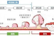 肠癌早期症状,警惕肠癌早期四大征兆