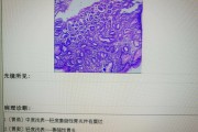 浅表萎缩性胃炎hp阳性浅表萎缩性胃炎