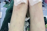 大腿小腿减肥左大腿外侧有麻木感