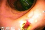 胃溃疡的症状,十二指肠溃疡的症状
