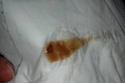小腹疼痛,小腹疼痛有大便的感觉