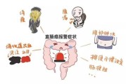 直肠癌早期的5大症状女性,直肠癌早期的5大症状