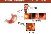 幽门螺旋杆菌感染治疗方案的简单介绍
