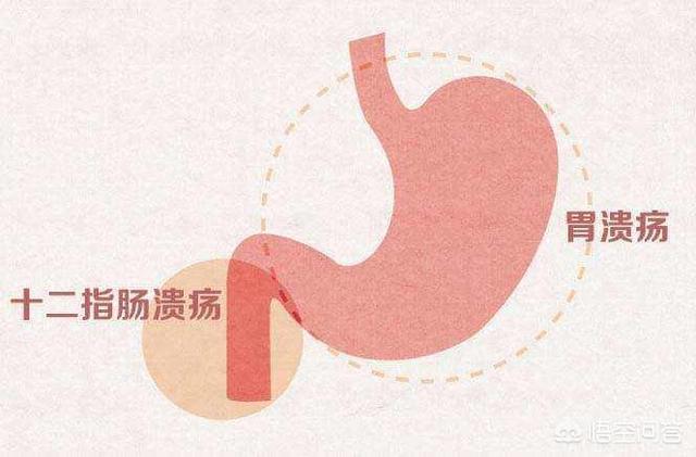 什么是消化性溃疡<strong>胃溃疡</strong>？