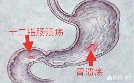 胃溃疡有哪些东西不能吃啊<strong>胃溃疡</strong>？