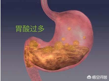 胃溃疡有哪些东西不能吃啊<strong>胃溃疡</strong>？