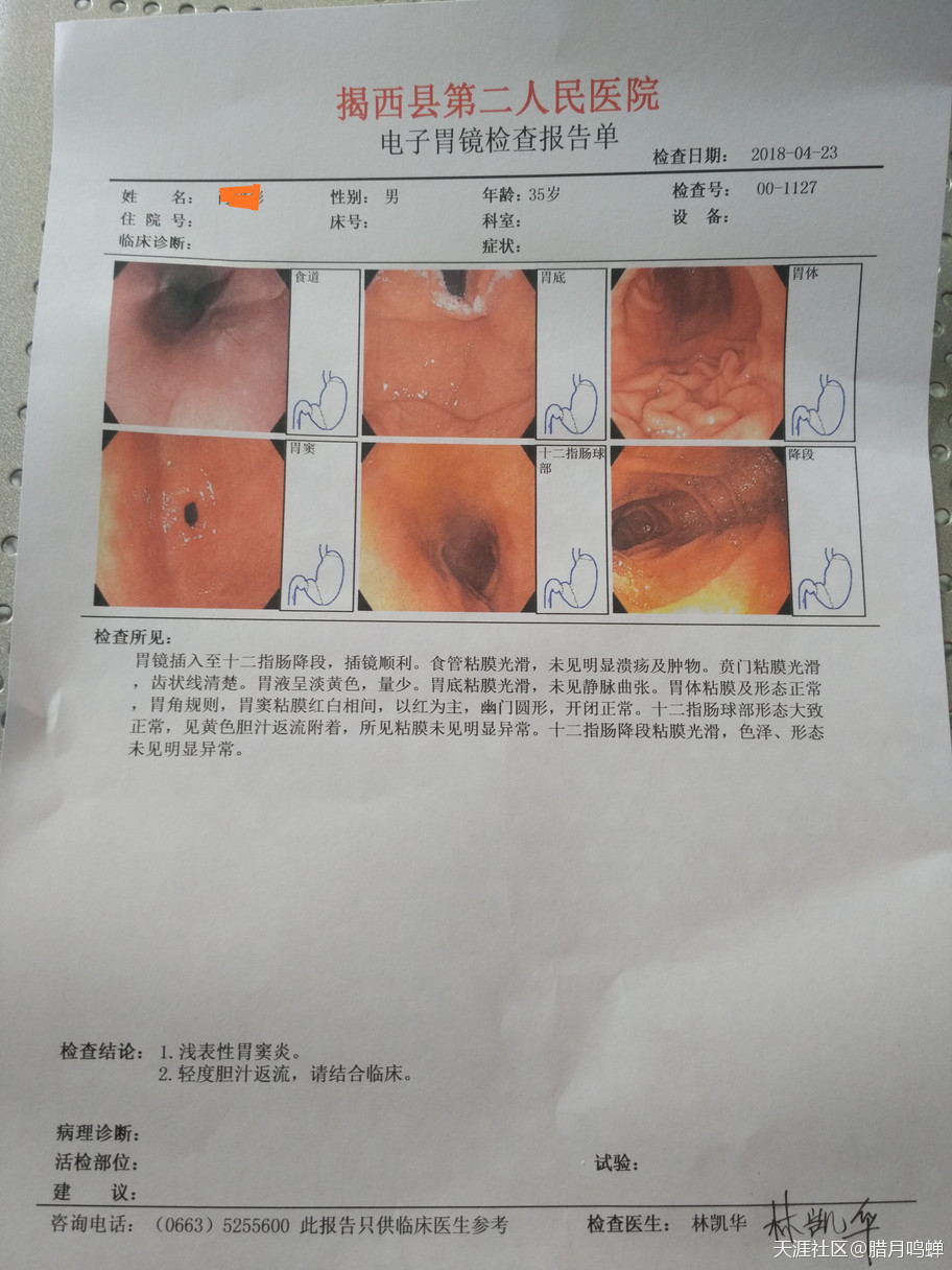 物理方法控制胆汁反流性胃炎