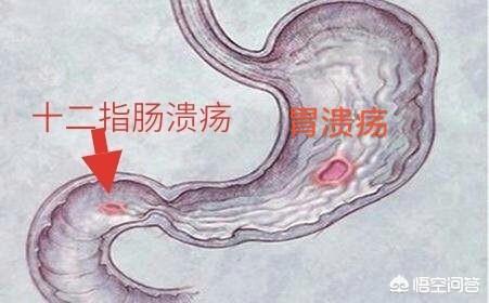 得了胃溃疡怎样调理<strong>胃溃疡</strong>？