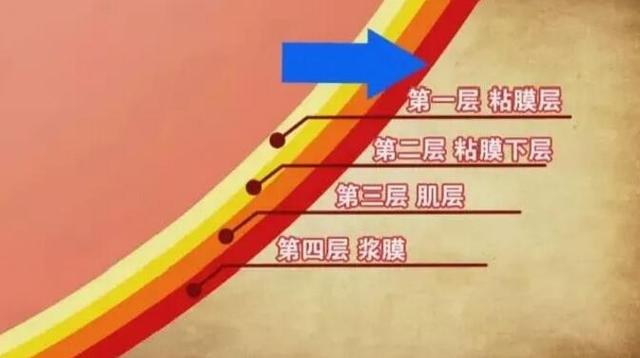 为什么会有人得胃溃疡<strong>胃溃疡</strong>？得了胃溃疡该怎么吃？